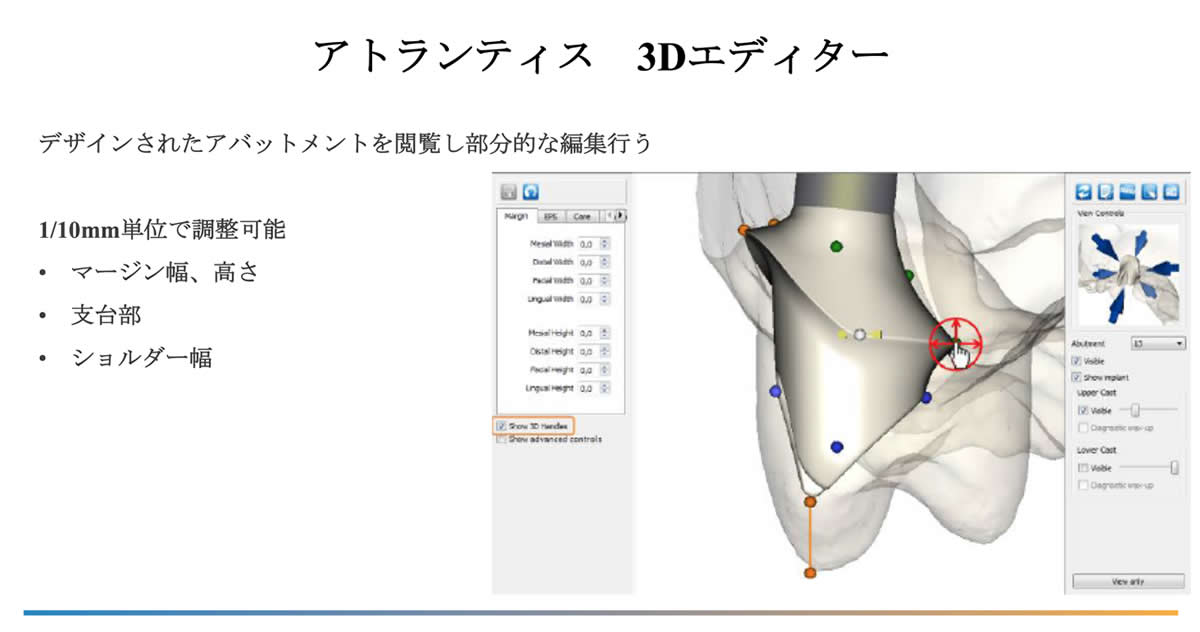 デジタルインプラント