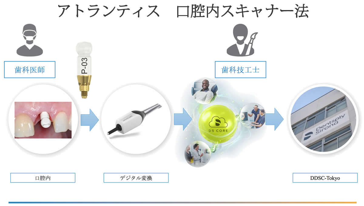 デジタルインプラント